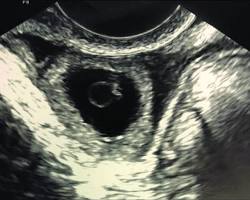 5-week pregnancy ultrasound showing the dark gestational sac and the white ring of the yolk sac